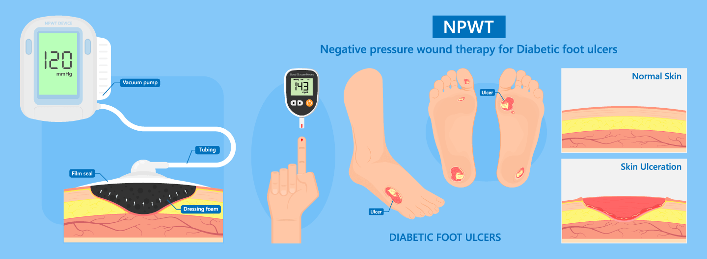 Negative Pressure Wound Therapy