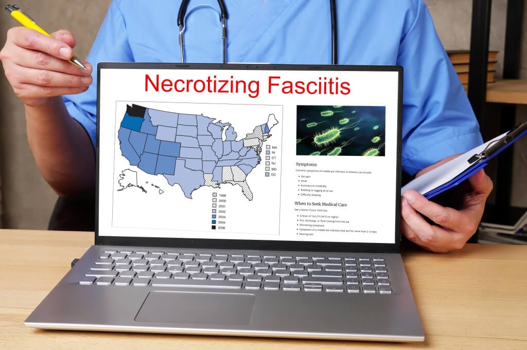 Necrotizing Fasciitis